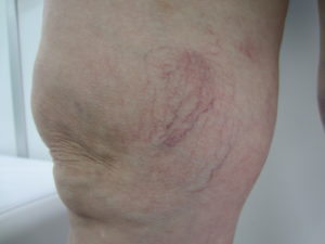 クモの巣静脈瘤