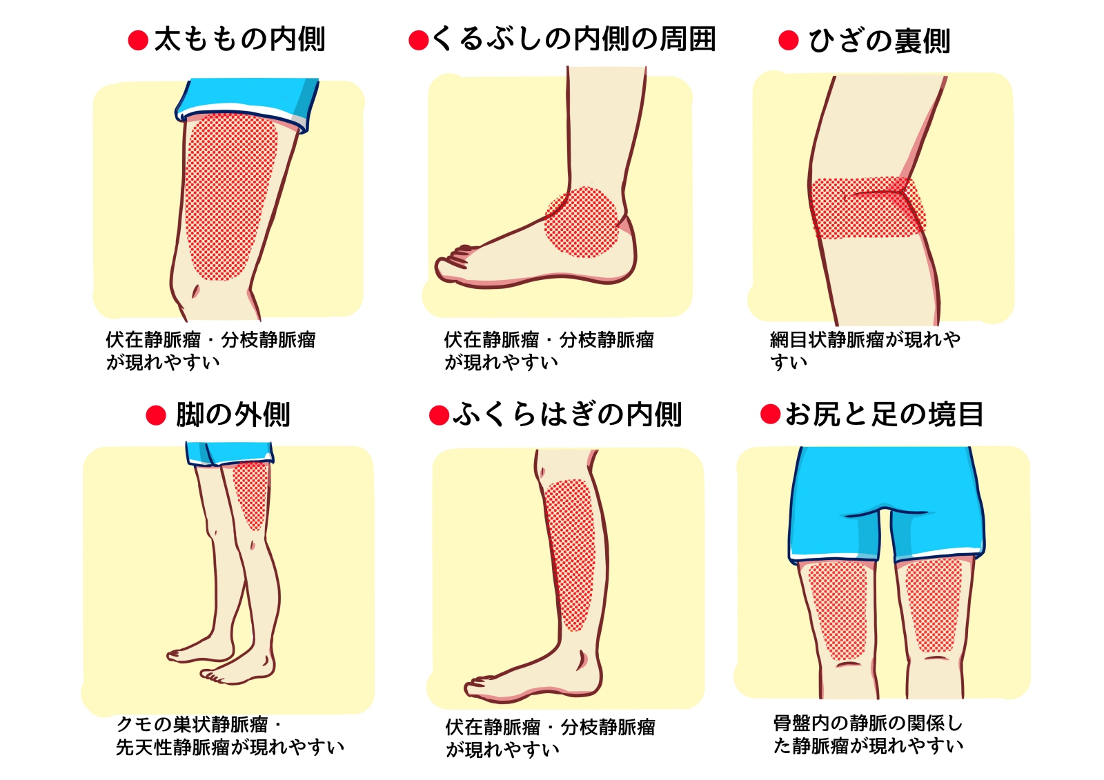 静脈がふくらんでしまう主な場所