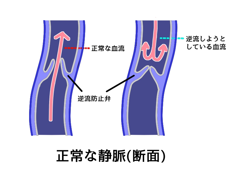 静脈の逆流防止弁