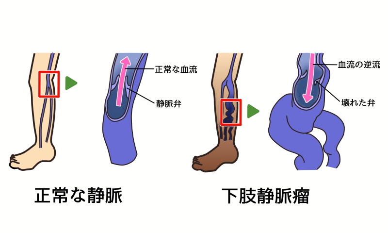 下肢静脈瘤と静脈弁の働き