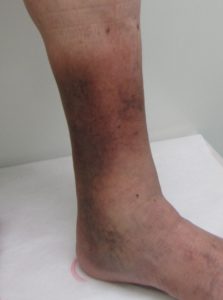 黒く変色した皮膚炎を伴う静脈瘤