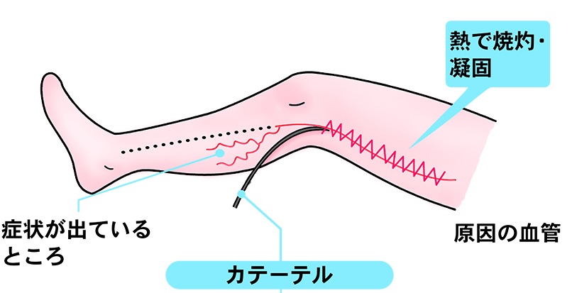 血管内焼灼のカテーテルの図