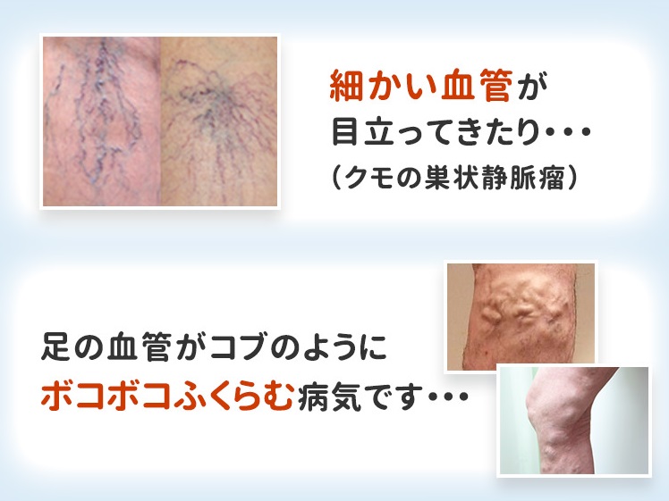 下肢静脈瘤はクモ状血管やコブがボコボコになる病気(sp)