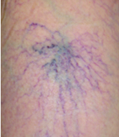 クモの巣状静脈瘤の画像