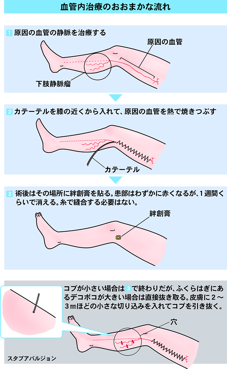 血管内焼灼術（レーザー・高周波）