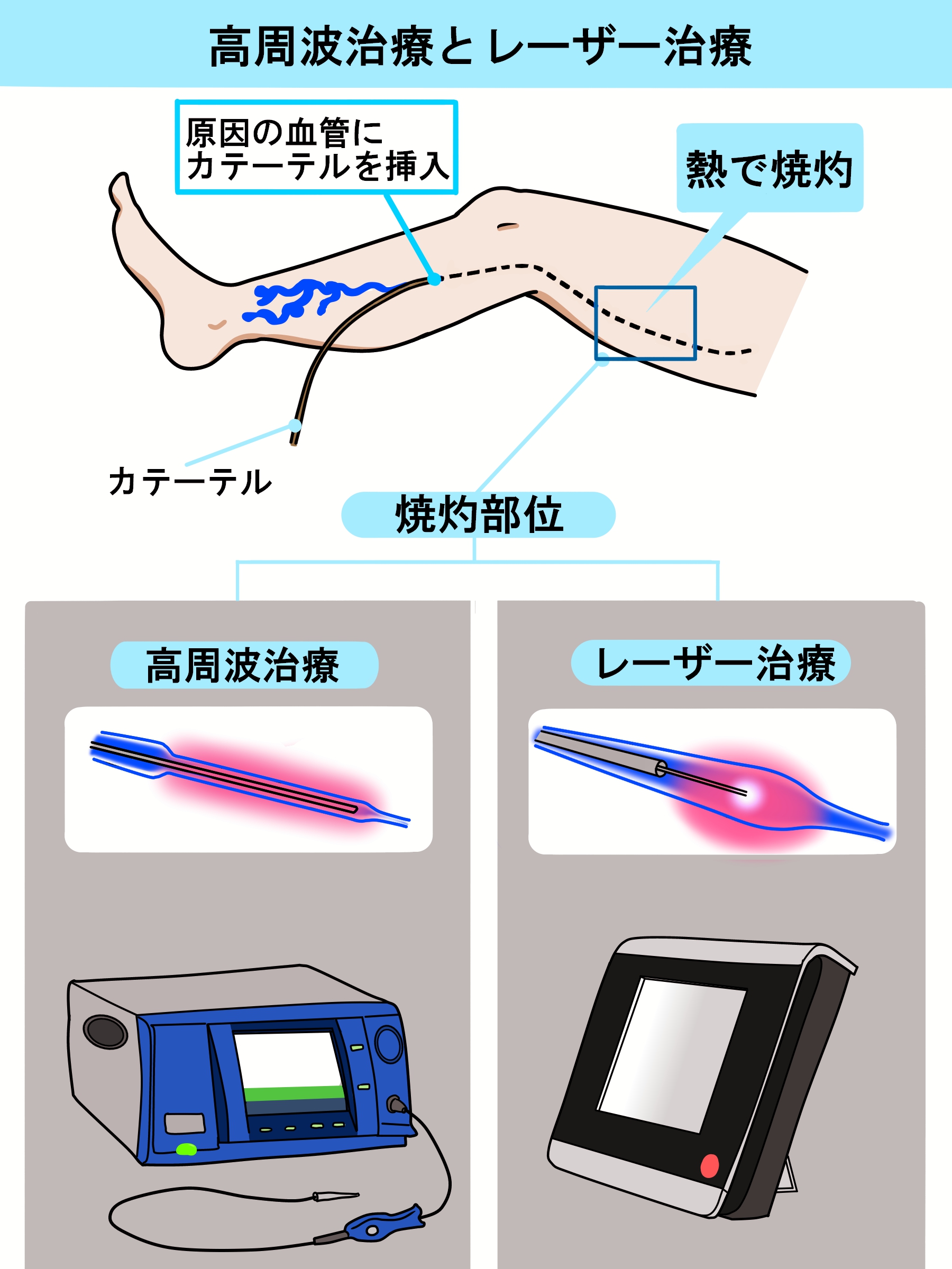 高周波治療とレーザー治療