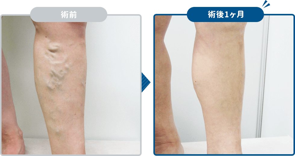 下肢静脈瘤レーザー治療術後