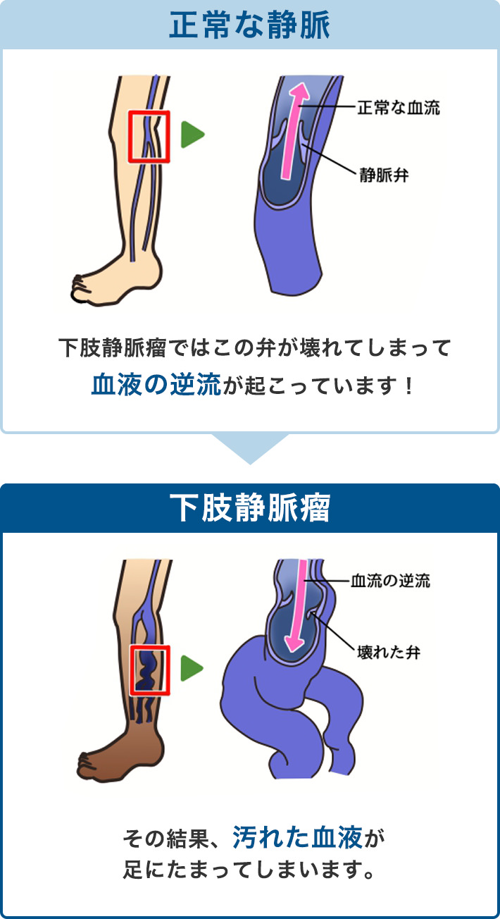 下肢静脈瘤では逆流防止弁が壊れている(SP)