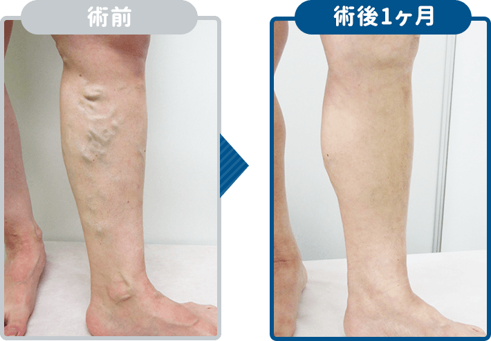 下肢静脈瘤レーザー治療術前後