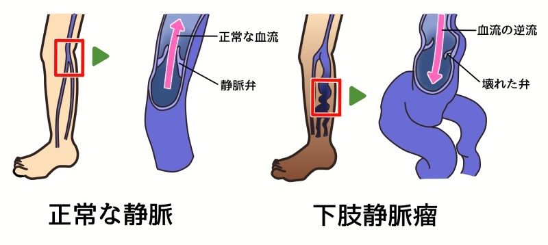 正常な静脈と下肢静脈瘤の違い