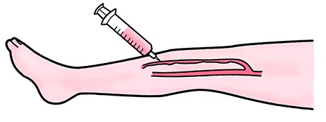 注射（硬化治療）