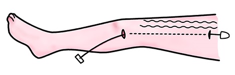 ストリッピング手術
