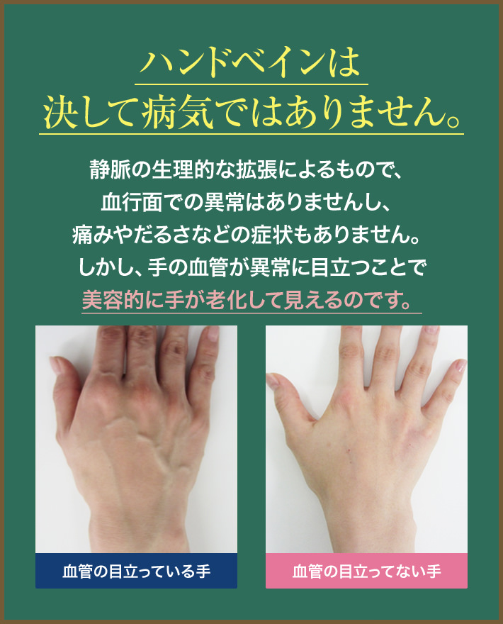 ハンドベインは決して病気ではありません。