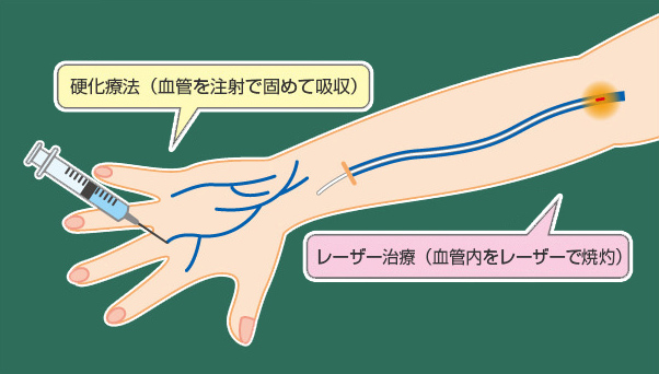 赤羽ウェルネスクリニックの治療法 硬化療法とレーザー治療の同時施行