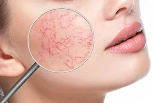 血管をピンポイントで消せる