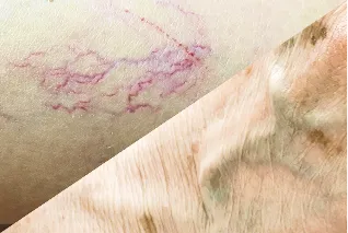 血管の太さに関係なく治療可能