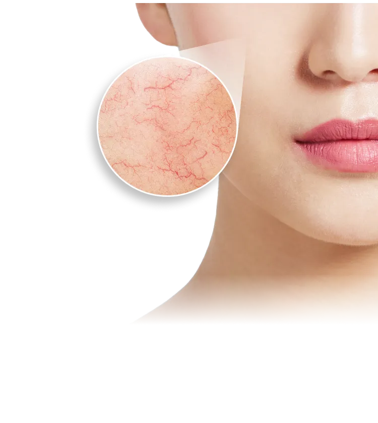 顔に浮き出た血管が気になる方へ 顔の硬化療法 顔の血管をピンポイントで消す