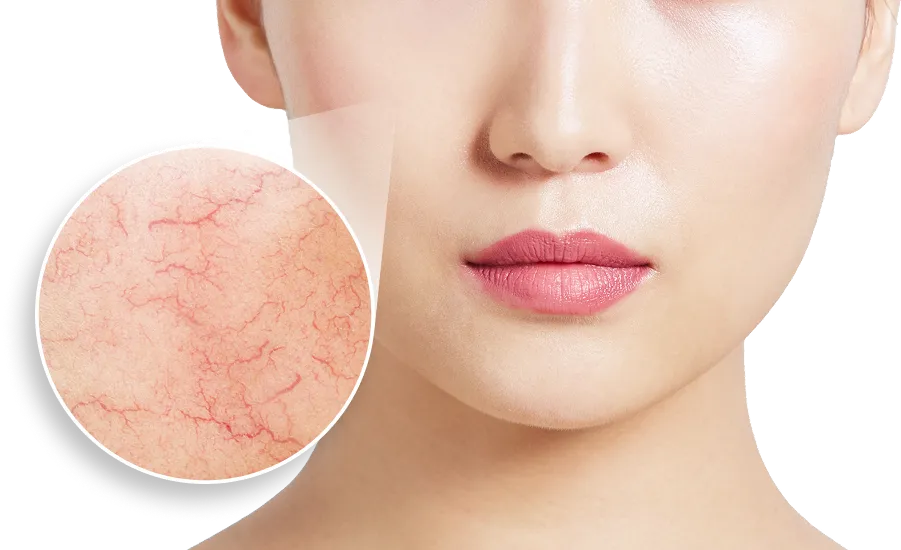 顔に浮き出た血管が気になる方へ 顔の硬化療法 顔の血管をピンポイントで消す