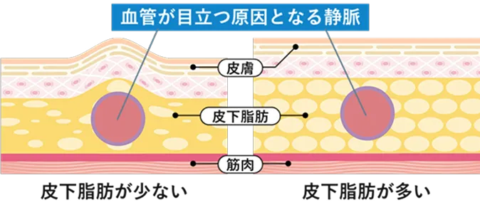加齢による皮膚の薄化