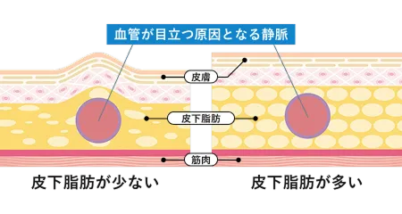 加齢による皮膚の薄化