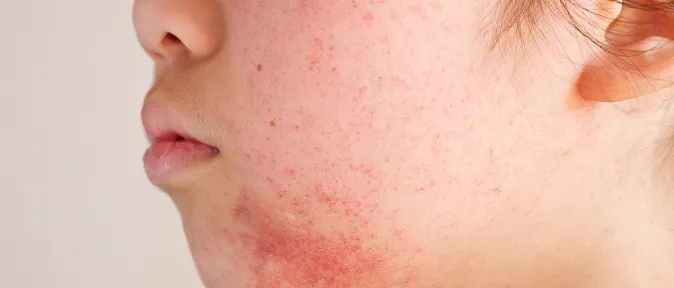 酒さ（しゅさ）