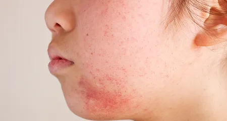 酒さ（しゅさ）