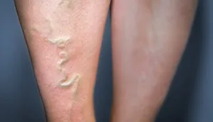 下肢静脈瘤 症例写真