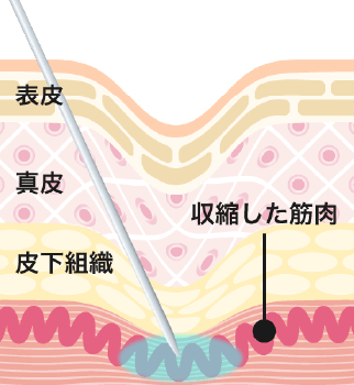 注入する部位、量、深さを調整しつつ、患部にボトックスを注入。
