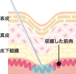 注入する部位、量、深さを調整しつつ、患部にボトックスを注入。