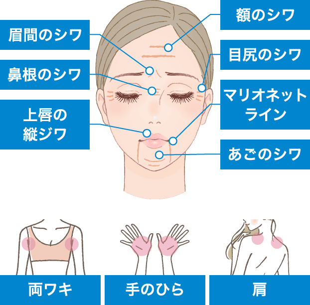 ボトックス注入の適応範囲