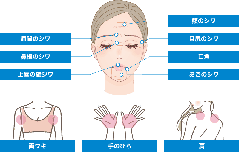 ボトックス注入の適応範囲
