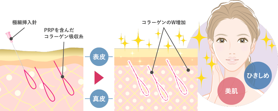 PRPを含んだコラーゲン吸収糸をフェイスラインや頬、顎下に挿入することで、コラーゲンがW (ダブル) 産生され、引き締まった輪郭になります。輪郭が引き締まることで、たるみの改善が期待できる上、コラーゲン生成も促されるため、お肌のハリや弾力感もアップします。