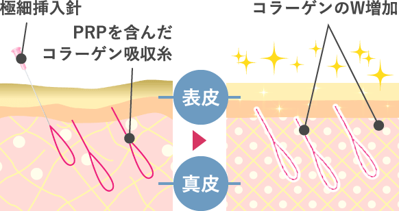 PRPを含んだコラーゲン吸収糸をフェイスラインや頬、顎下に挿入することで、コラーゲンがW (ダブル) 産生され、引き締まった輪郭になります。輪郭が引き締まることで、たるみの改善が期待できる上、コラーゲン生成も促されるため、お肌のハリや弾力感もアップします。