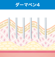 超極細針で微細な穴を皮膚に開けます。