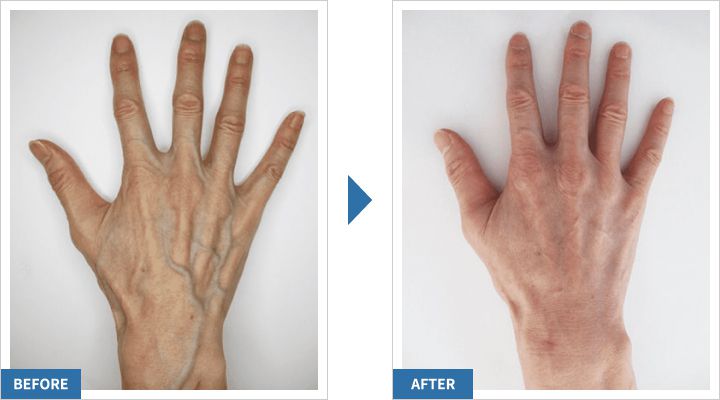 ハンドベインは病気ではありません