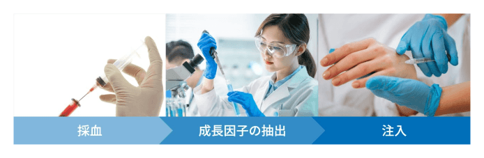 採血 成長因子の抽出 注入
