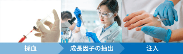 採血 成長因子の抽出 注入