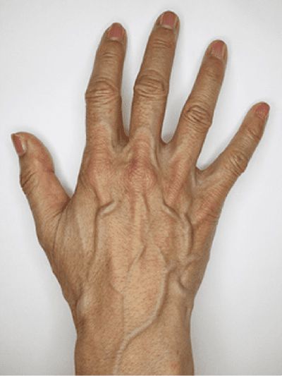 ハンドベインとは?