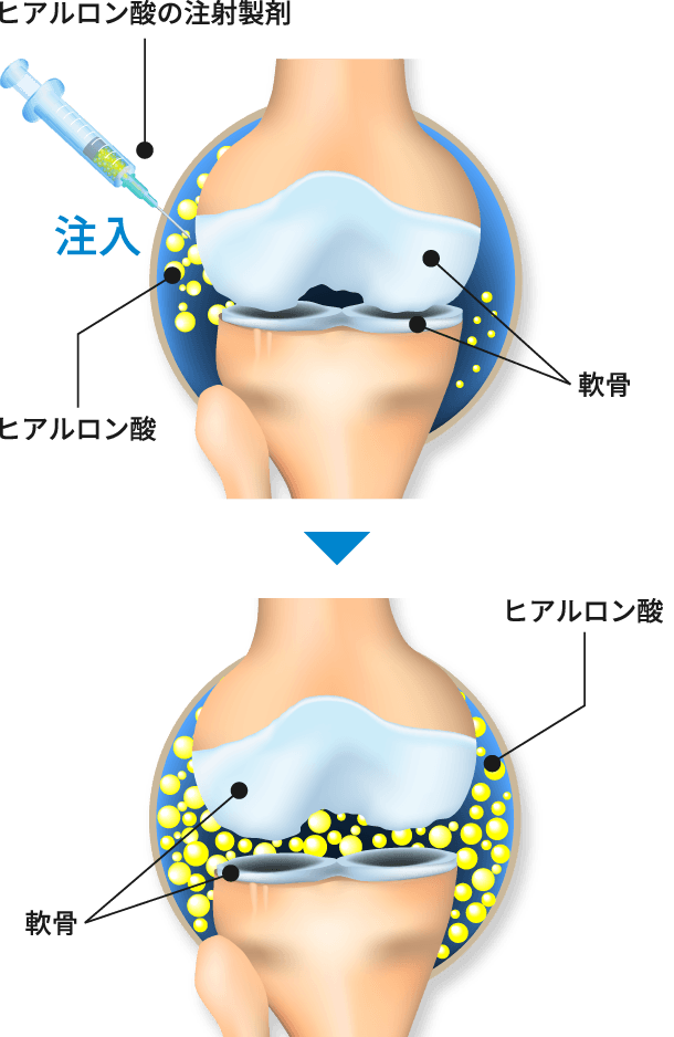 ヒアルロン酸注射