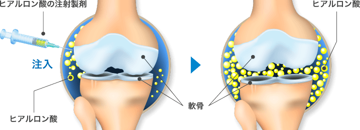 ヒアルロン酸注射