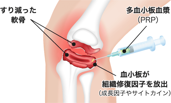PRP注射との違い