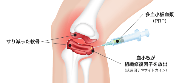 PRP注射との違い