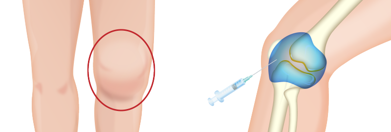関節穿刺