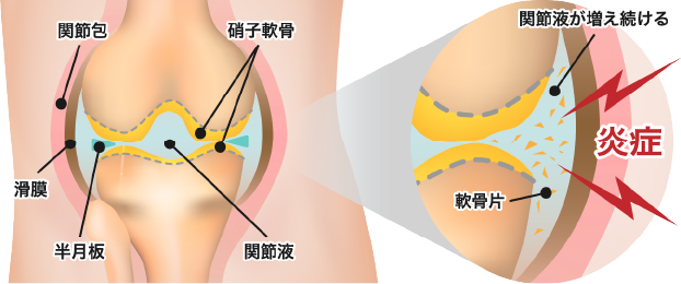 PRP注射との違い