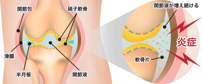 PRP注射との違い