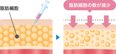 脂肪溶解スリム注射とは？