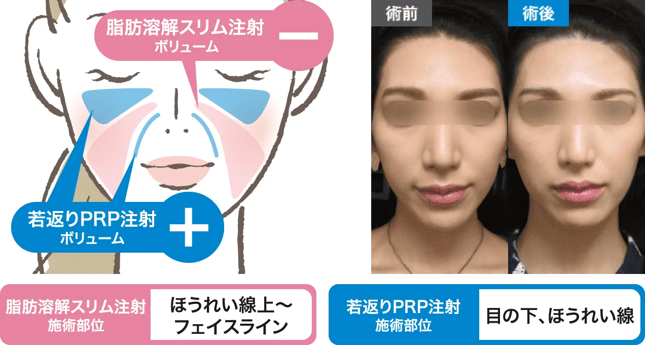 ほうれい線上～フェイスライン・目の下、ほうれい線