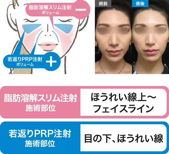 ほうれい線上～フェイスライン・目の下、ほうれい線