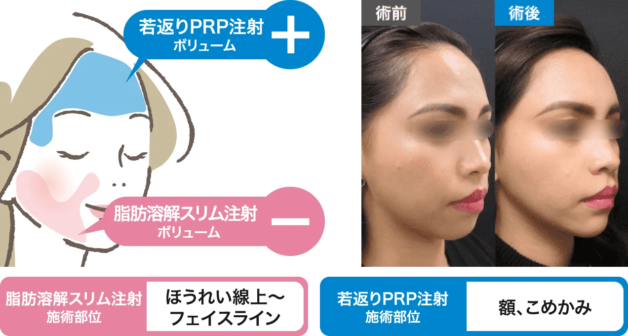 ほうれい線上～フェイスライン・額、こめかみ