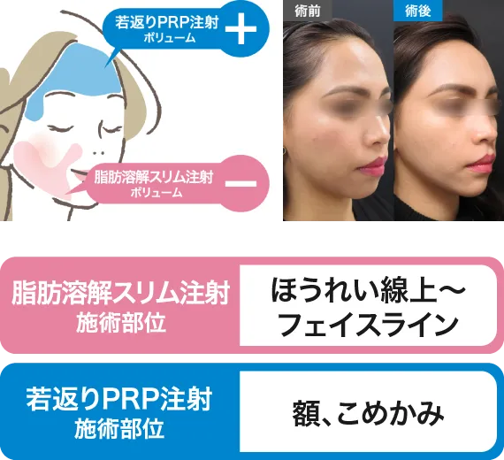 ほうれい線上～フェイスライン・額、こめかみ